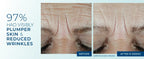 Before and after comparison of plumper skin and reduced wrinkles on a person's face.