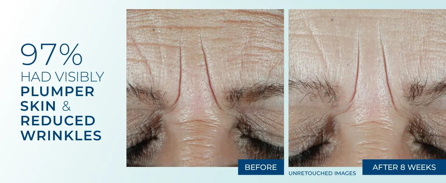 Before and after comparison of plumper skin and reduced wrinkles on a person's face.